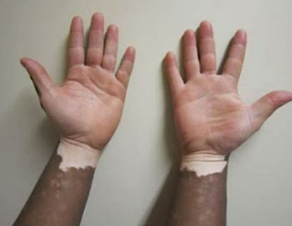 vitiligo